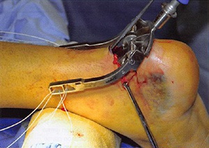 Mini-Open Repair of Achilles Rupture in the National Football League